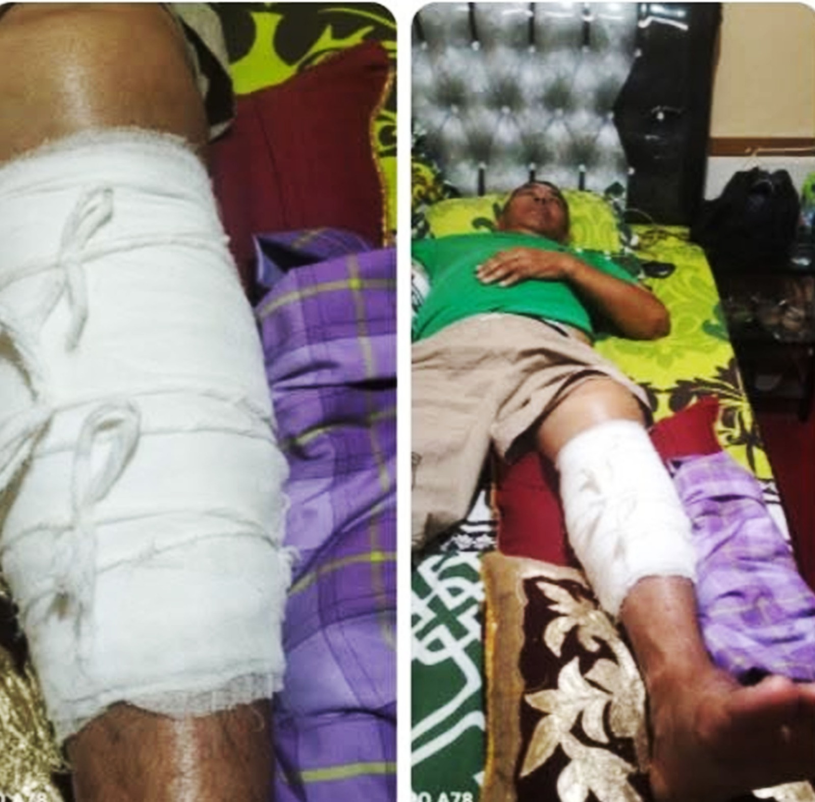 Kondisi Trikora Irianto, patah tulang kaki kiri karena kecelakaan lalin sebelum operasi tindakan medis di RSUP M Jamil Padang beberapa hari lalu